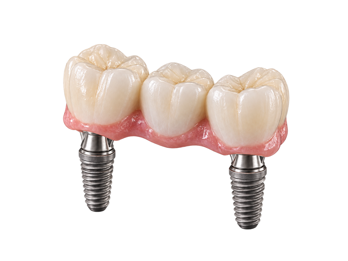 Conceptual illustration of dental implants